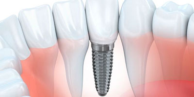 Imagen implante dental Almería